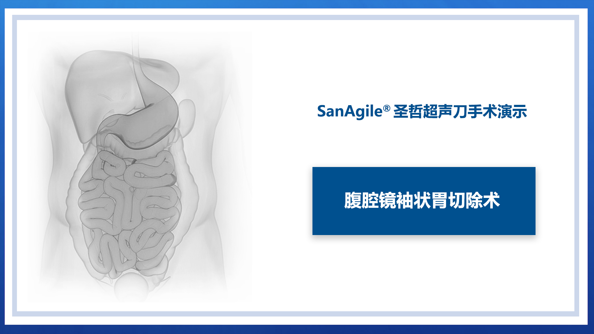 腹腔镜胃袖状切除术