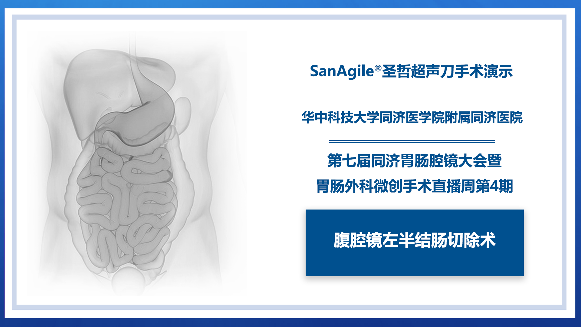 腹腔镜左半结肠切除术