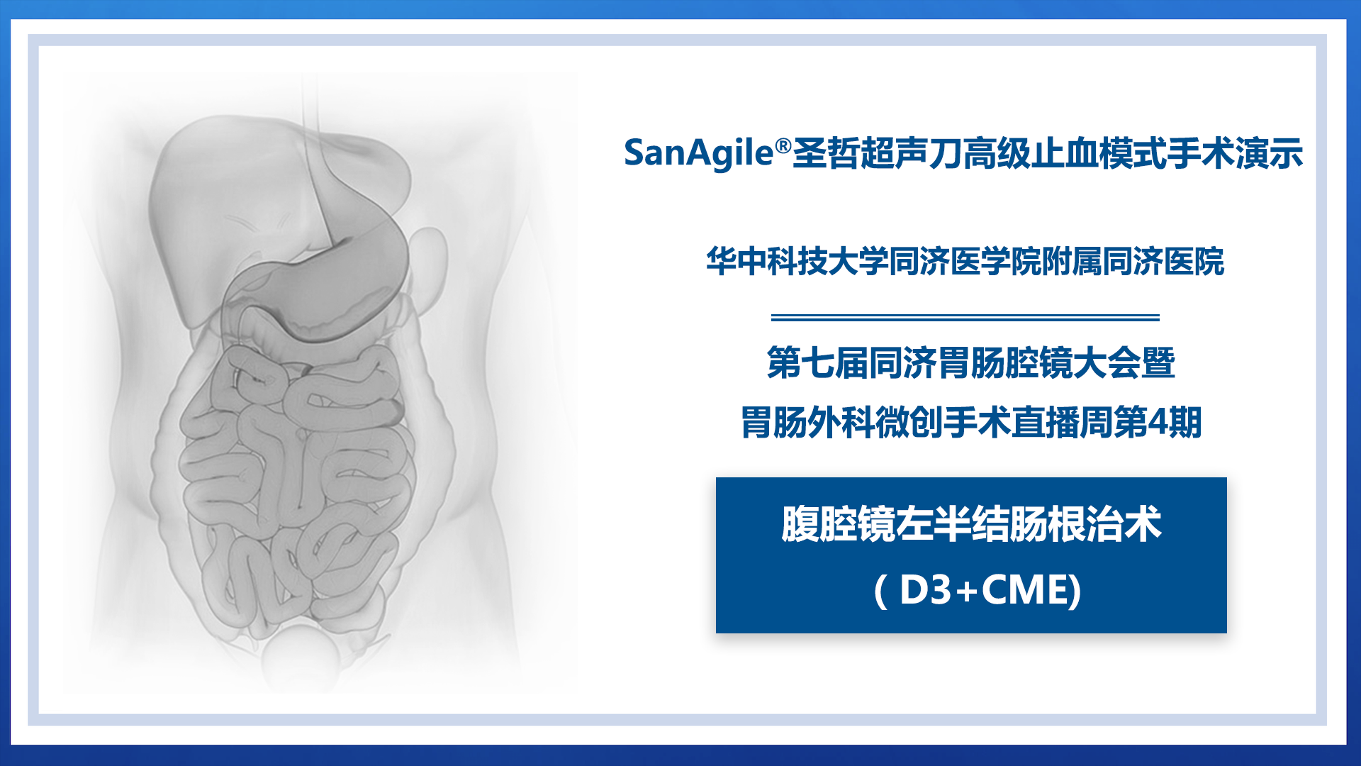 腹腔镜左半结肠根治术（D3+CME)（高级止血模式）